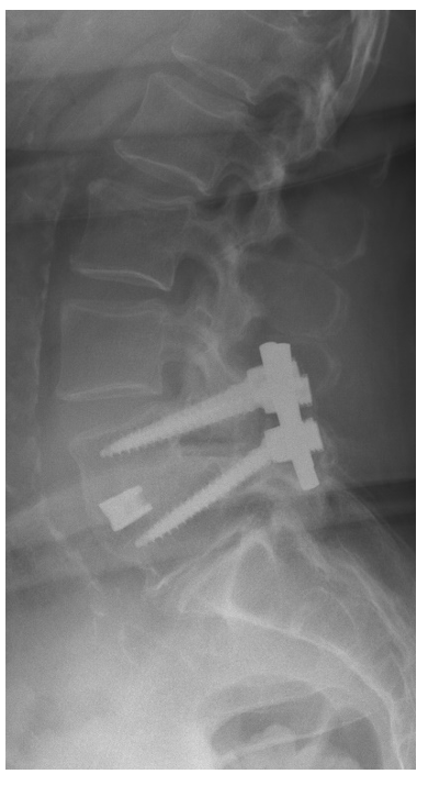 Grade 2 L4-5 Spondylolisthesis