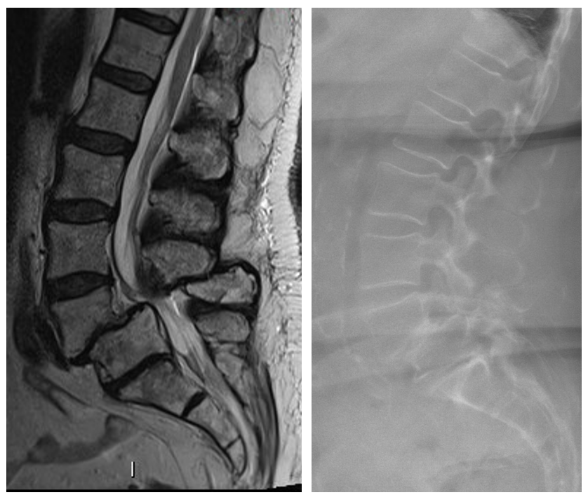 Grade 2 L4-5 Spondylolisthesis