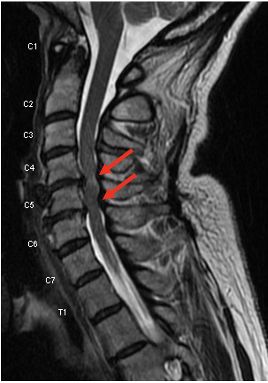 Pre-op: severe spinal cord compression at C4-6 (red arrows)