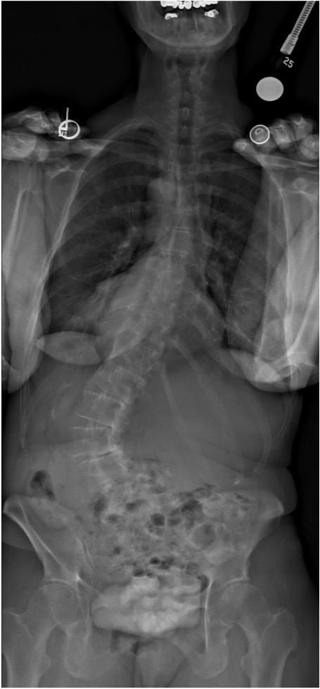 Patient with adult idiopathic scoliosis