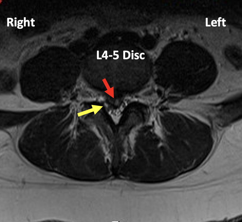 Microdiscectomy Dr. Justin Smith