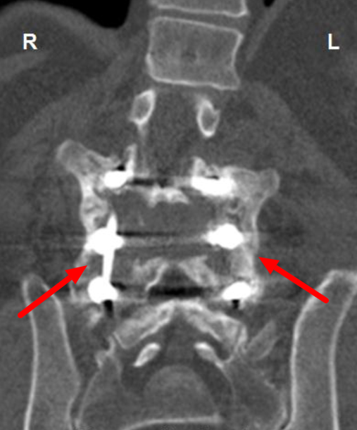 Spinal Fusion Dr. Justin Smith