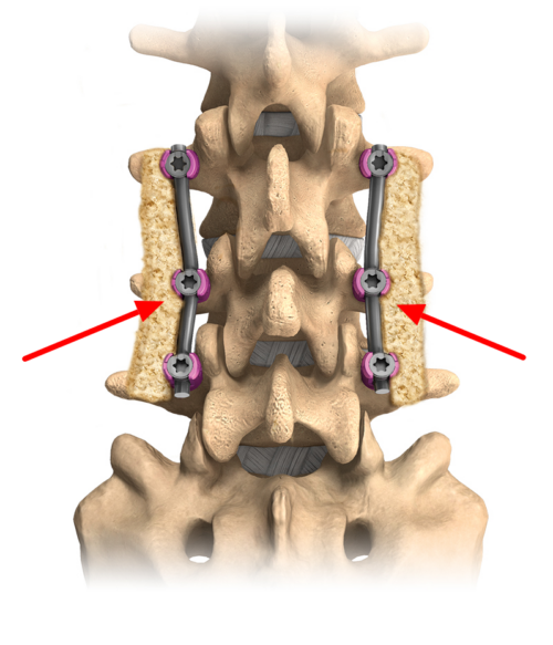 Spinal Fusion Dr Justin Smith spinal-fusion-dr-justin-smith